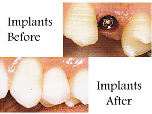 Image showing a titanium root screw dental implant before fitting the tooth or crown, and after the fitting.