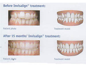 Image showing a patients teeth before and after Invisalign treatment at our Dental Practice in Congleton.
