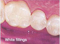 Picture of teeth with white fillings which are almost invisible, unlike the old amalgamn fillings.