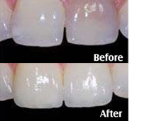 Crowns before and after treatment