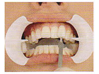 Picture of teeth after undergoing our teeth whitening process.