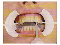 Picture of teeth before undergoing our teeth whitening process.