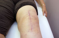 Picture of a knee after surgery, showing a long vertical scar. Physiotherapy can help to reduce the scar.